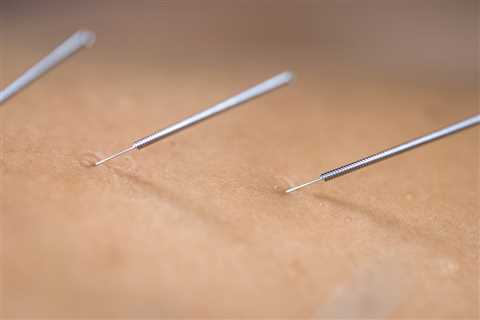 THE BENEFITS OF ACUPUNCTURE FOR MENTAL HEALTH