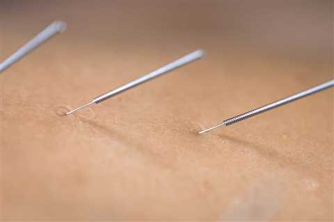 THE BENEFITS OF ACUPUNCTURE FOR MENTAL HEALTH