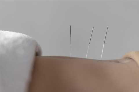 THE BENEFITS OF ACUPUNCTURE FOR ENDOMETRIOSIS-RELATED FERTILITY ISSUES