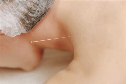 THE BENEFITS OF ACUPUNCTURE FOR CHRONIC PAIN IN CANCER SURVIVORS